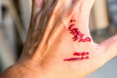 What To Do Right After a Dog Bite Health Legal and Reporting Steps