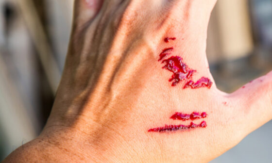 What To Do Right After a Dog Bite Health Legal and Reporting Steps