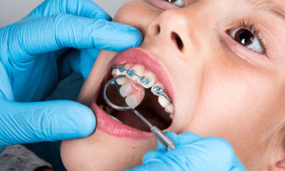 How Early Orthodontic Treatment Helps Children In Johns Creek