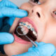 How Early Orthodontic Treatment Helps Children In Johns Creek