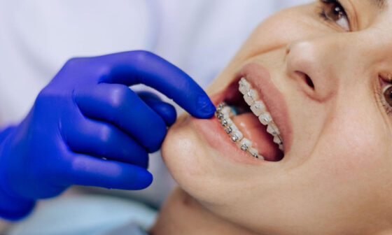 What Patients Overlook Before Starting Orthodontic Treatment in Las Vegas