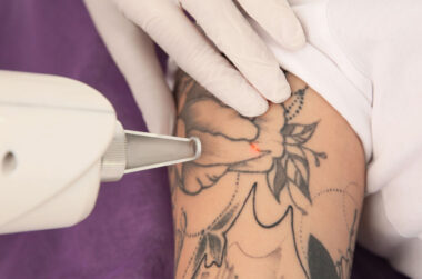 What to Know Before Scheduling Laser Tattoo Removal