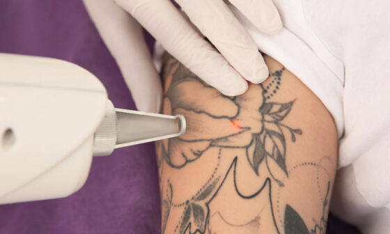What to Know Before Scheduling Laser Tattoo Removal