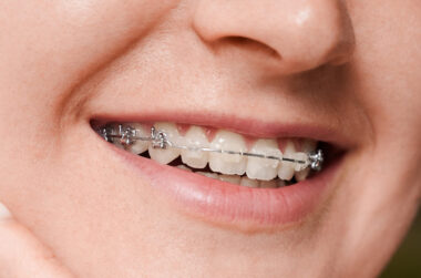A Guide to Understanding Braces Options in South Surrey