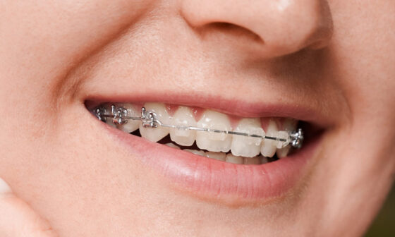 A Guide to Understanding Braces Options in South Surrey