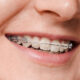 A Guide to Understanding Braces Options in South Surrey