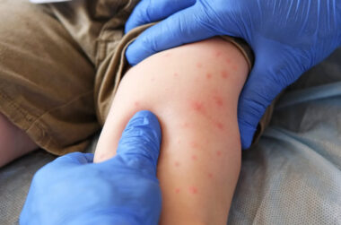 Can You Get Measles Twice