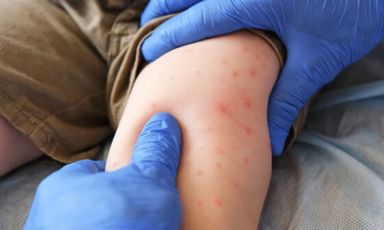 Can You Get Measles Twice