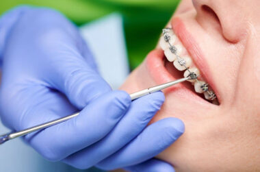 Tips for Maintaining Oral Hygiene with Braces in Winnipeg