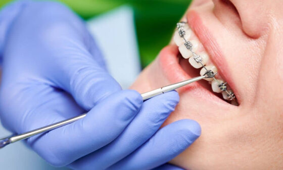 Tips for Maintaining Oral Hygiene with Braces in Winnipeg