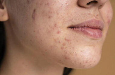 Ways to Treat Combination Skin With Breakouts and Scars