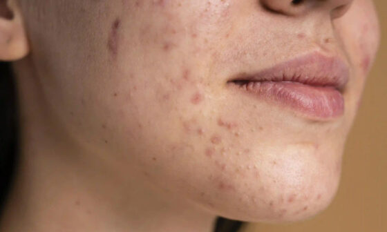 Ways to Treat Combination Skin With Breakouts and Scars