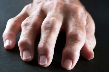 What Is Rheumatoid Arthritis