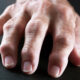 What Is Rheumatoid Arthritis