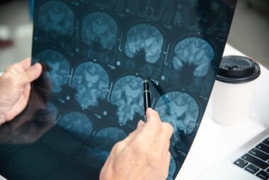Brain Injury Claims Explained