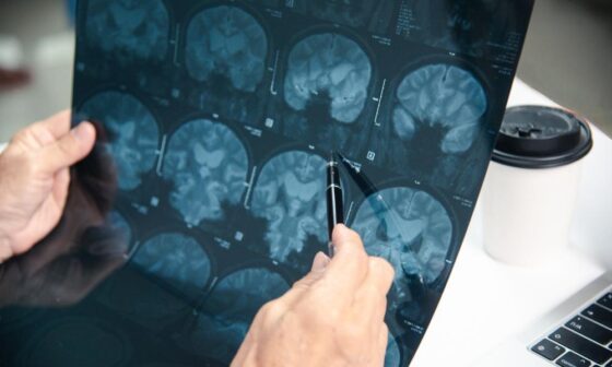 Brain Injury Claims Explained