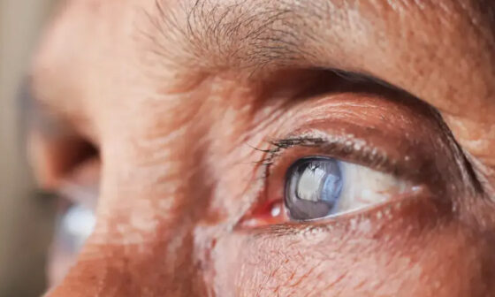 Signs Your Eye Is Healing Normally After Cataract Treatment