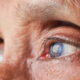 Signs Your Eye Is Healing Normally After Cataract Treatment