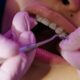 A Beginners Guide to Modern Orthodontic Treatment Options