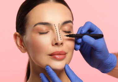 Rhinoplasty