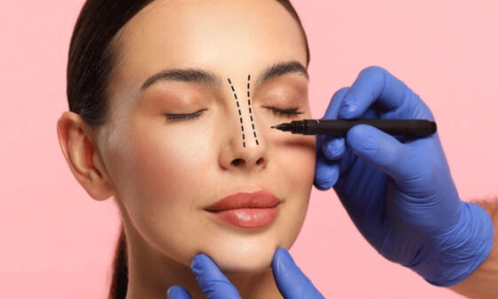 Rhinoplasty