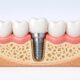 The Advantages of Modern Dental Implant Placement
