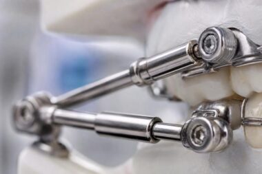 How Does OrthoDenco Orthodontic Labs Herbst Appliance Correct Class II Malocclusion Treatment Timeline Comfort and Adjustment