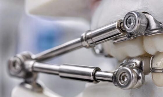 How Does OrthoDenco Orthodontic Labs Herbst Appliance Correct Class II Malocclusion Treatment Timeline Comfort and Adjustment