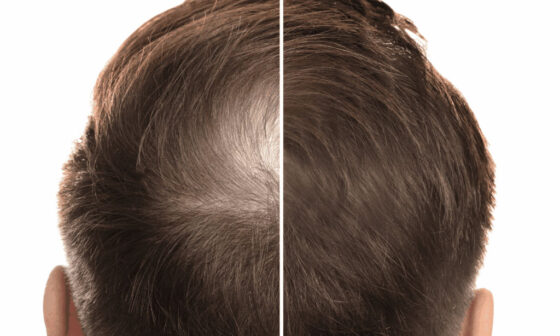 Why Wider Frontals Are Changing How Stylists Approach Hairlines