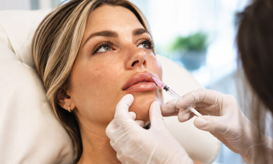 How to Think About Lip Fillers Before You Book